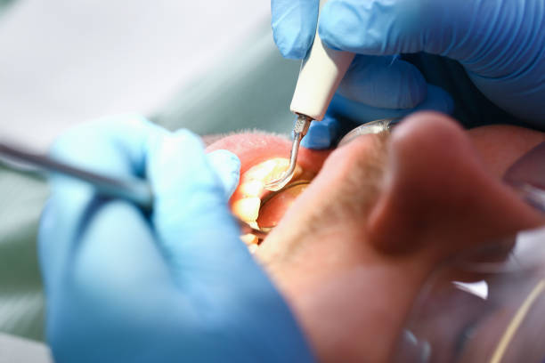 Best Urgent Care for Lost Fillings or Crowns in Pico Rivera, CA