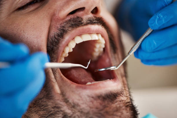 Best Emergency Treatment for Dental Infections or Abscesses in Pico Rivera, CA
